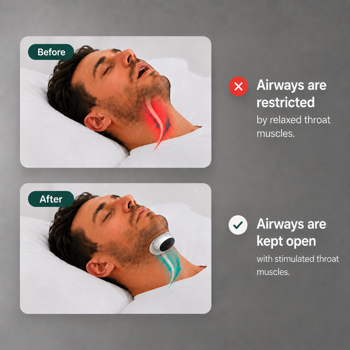 Micro Pulse Anti-Snore Device